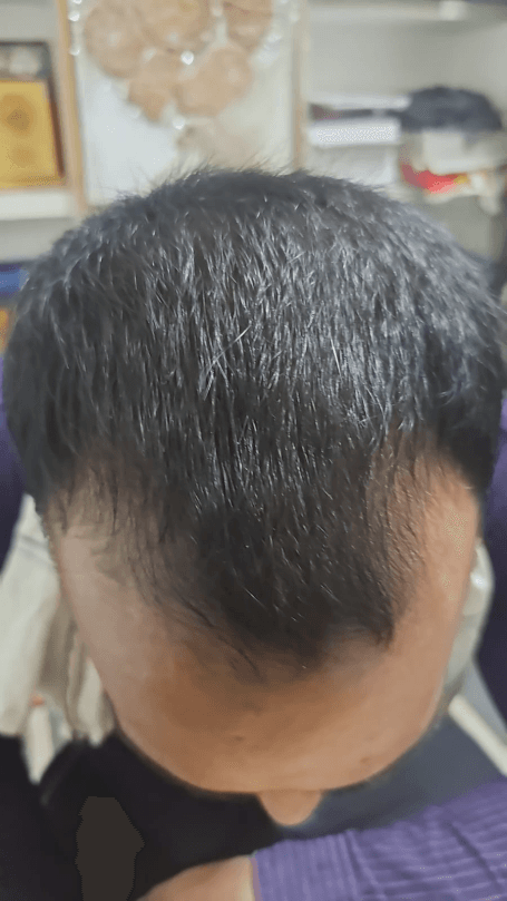 Hair Fall Treatment - After