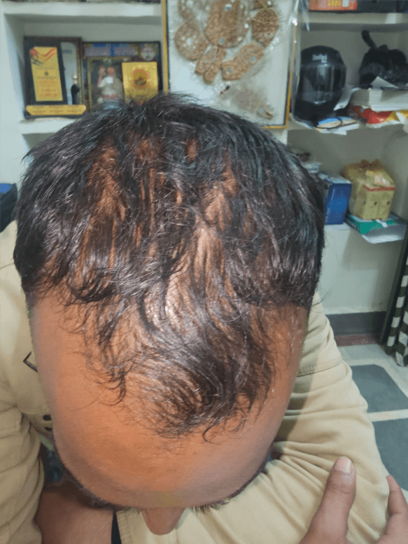Hair Fall Treatment - Before