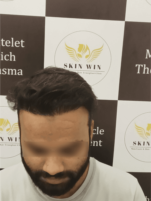 Hair Transplant after