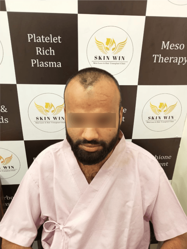 Hair Transplant before
