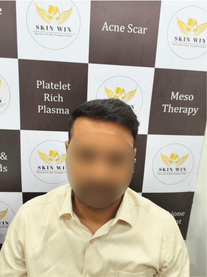 Hair Transplant (FUE/DHI) - After