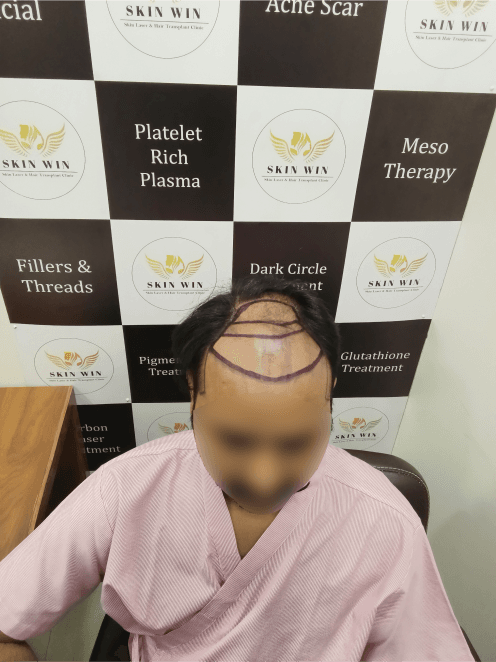 Hair Transplant (FUE/DHI) - Before