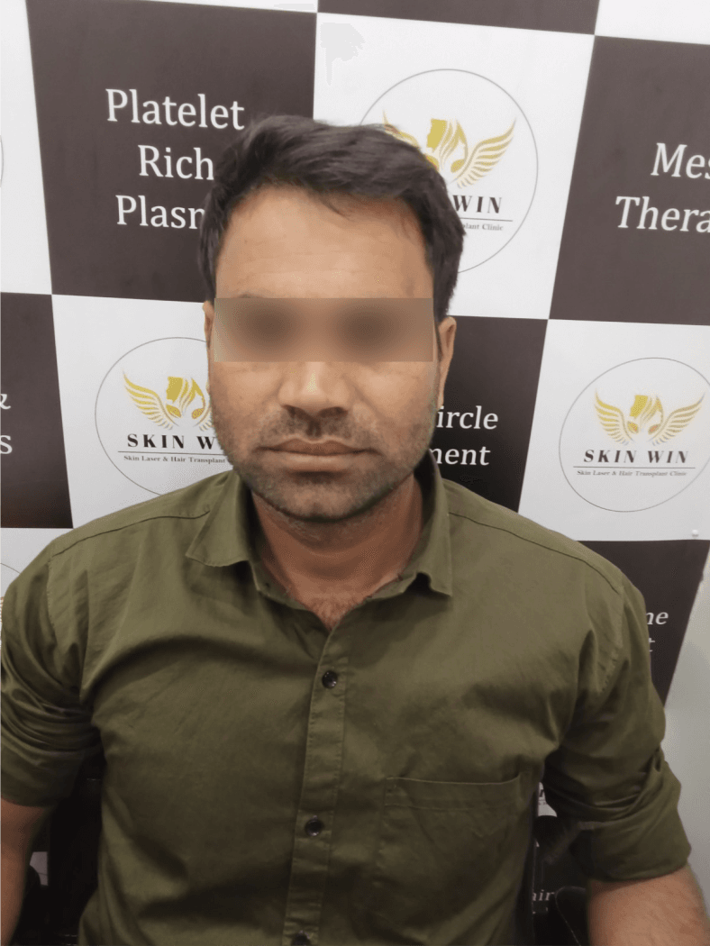 Hair Transplant (FUE/DHI) - After