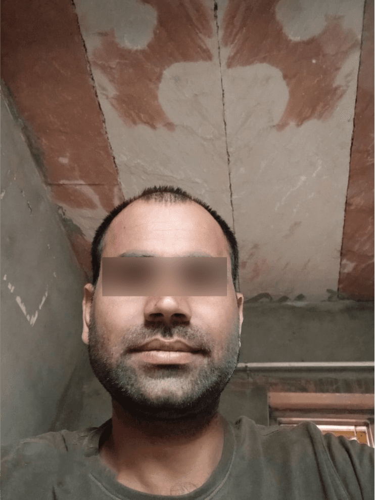 Hair Transplant (FUE/DHI) - Before