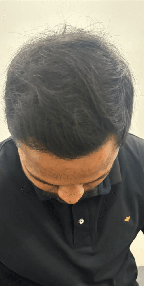 Hair Transplant (FUE/DHI) - After