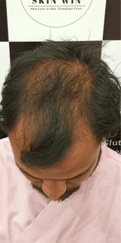 Hair Transplant (FUE/DHI) - Before
