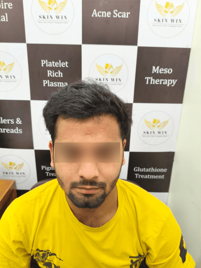 Hair Transplant (FUE/DHI) - After