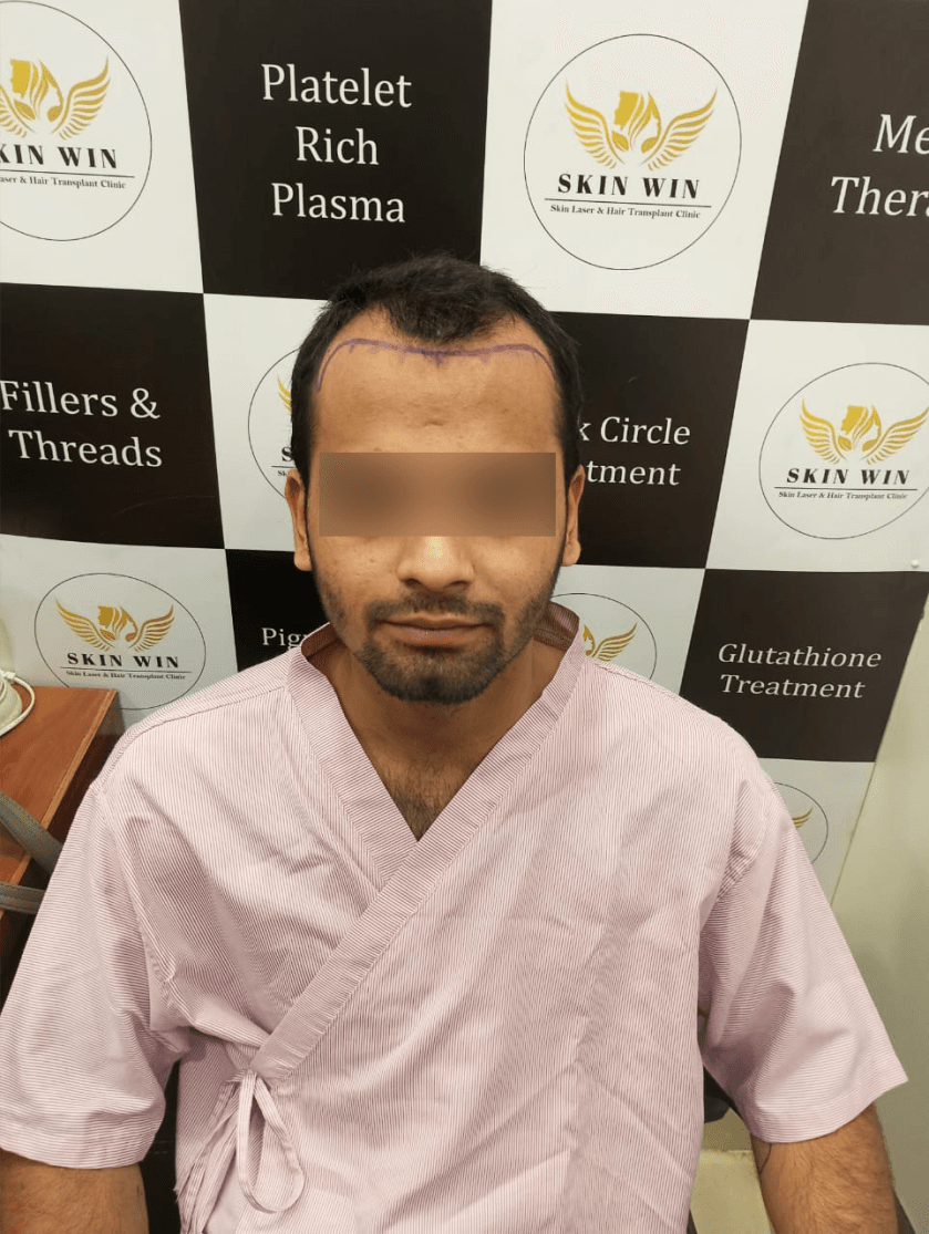 Hair Transplant (FUE/DHI) - Before