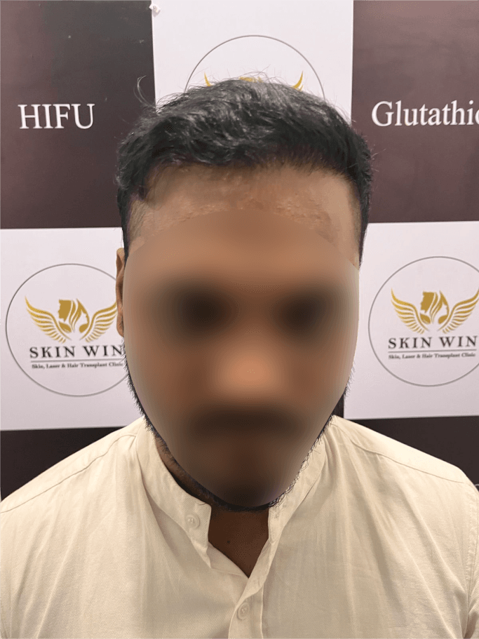 Hair Transplant (FUE/DHI) - After