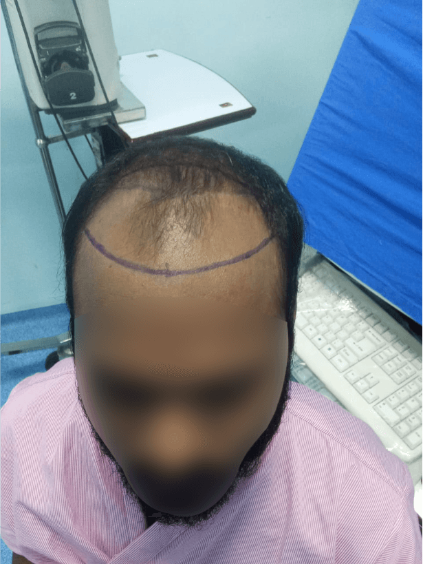 Hair Transplant (FUE/DHI) - Before