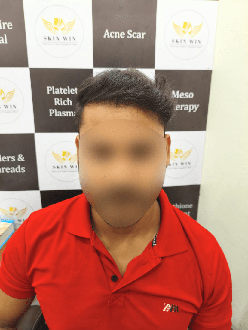 Hair Transplant (FUE/DHI) - After
