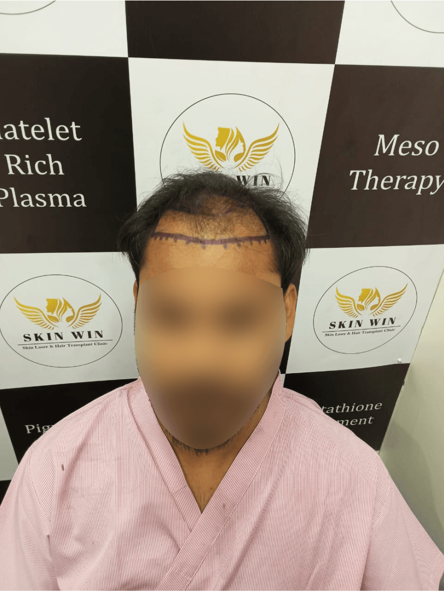 Hair Transplant (FUE/DHI) - Before