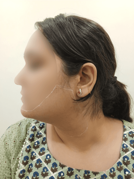 Laser Hair Reduction - After