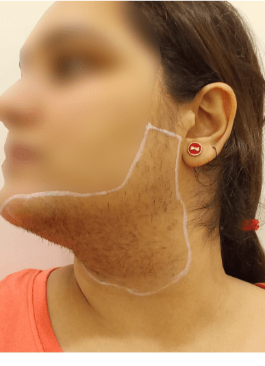 Unwanted Body Hair