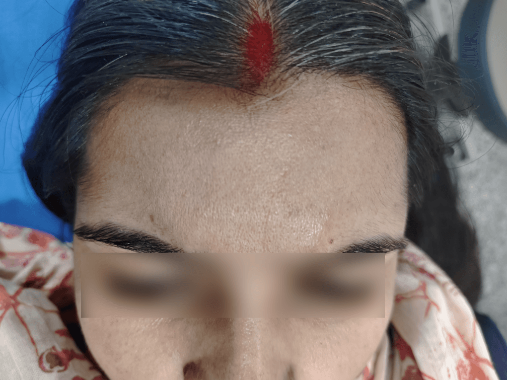Mole Removal - After