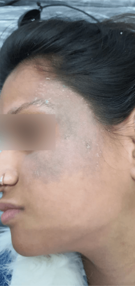 Nevus of OTA Treatment - After