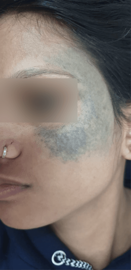 Birthmarks