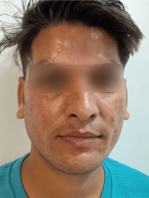 Pigmentation Removal after