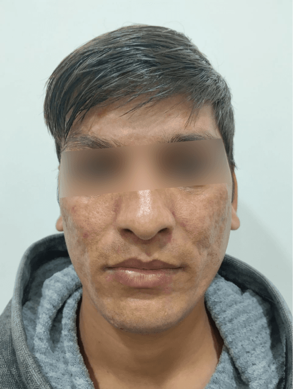 Pigmentation Removal before