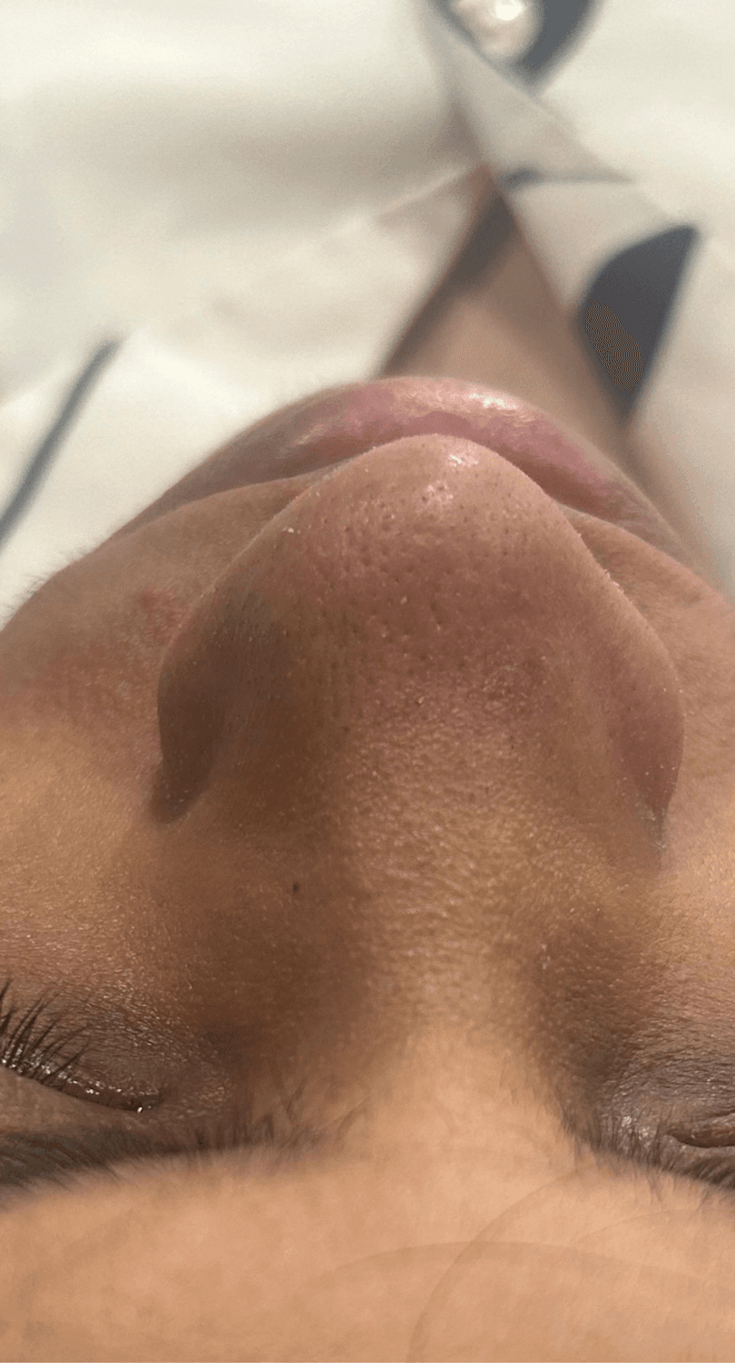 Pore Clarifying Treatment - After