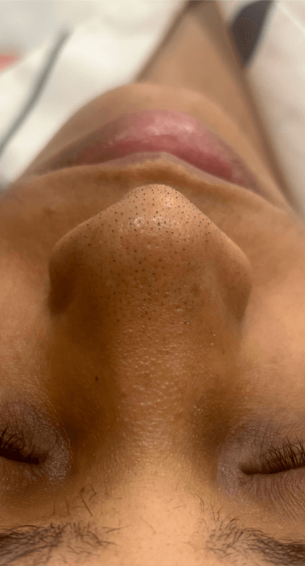 Pore Clarifying Treatment - Before