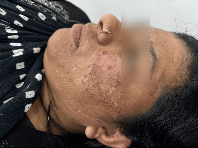 DPN Removal - After