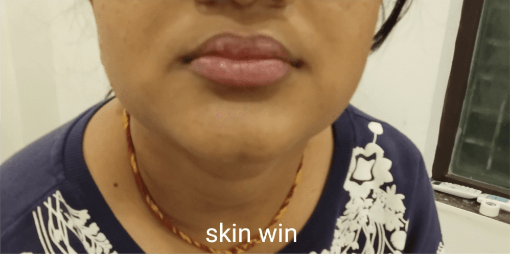 Vitiligo Treatment - After