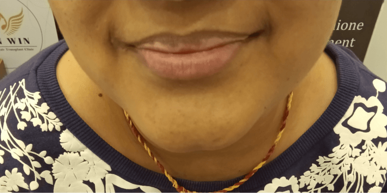 White Spots (Vitiligo)